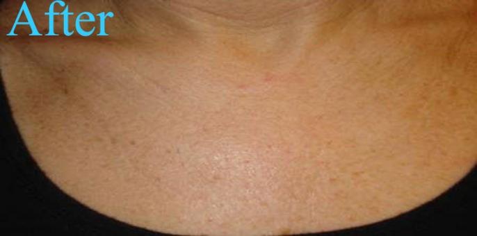 Prevent chest wrinkles - Get yourself the investment of the life time